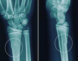 radiografía de fractura pequeña